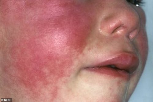 uk-scarlet-fever-outbreak-is-highest-in-50-years-whoobly